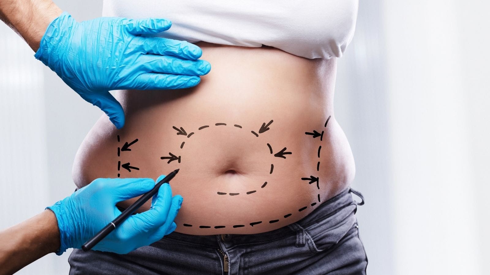 Lipoaspiração é um procedimento simples? Médicos pontuam riscos da cirurgia