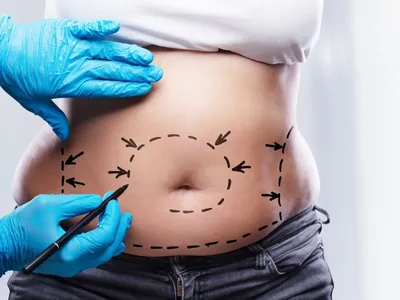 Lipoaspiração é um procedimento simples? Médicos pontuam riscos da cirurgia