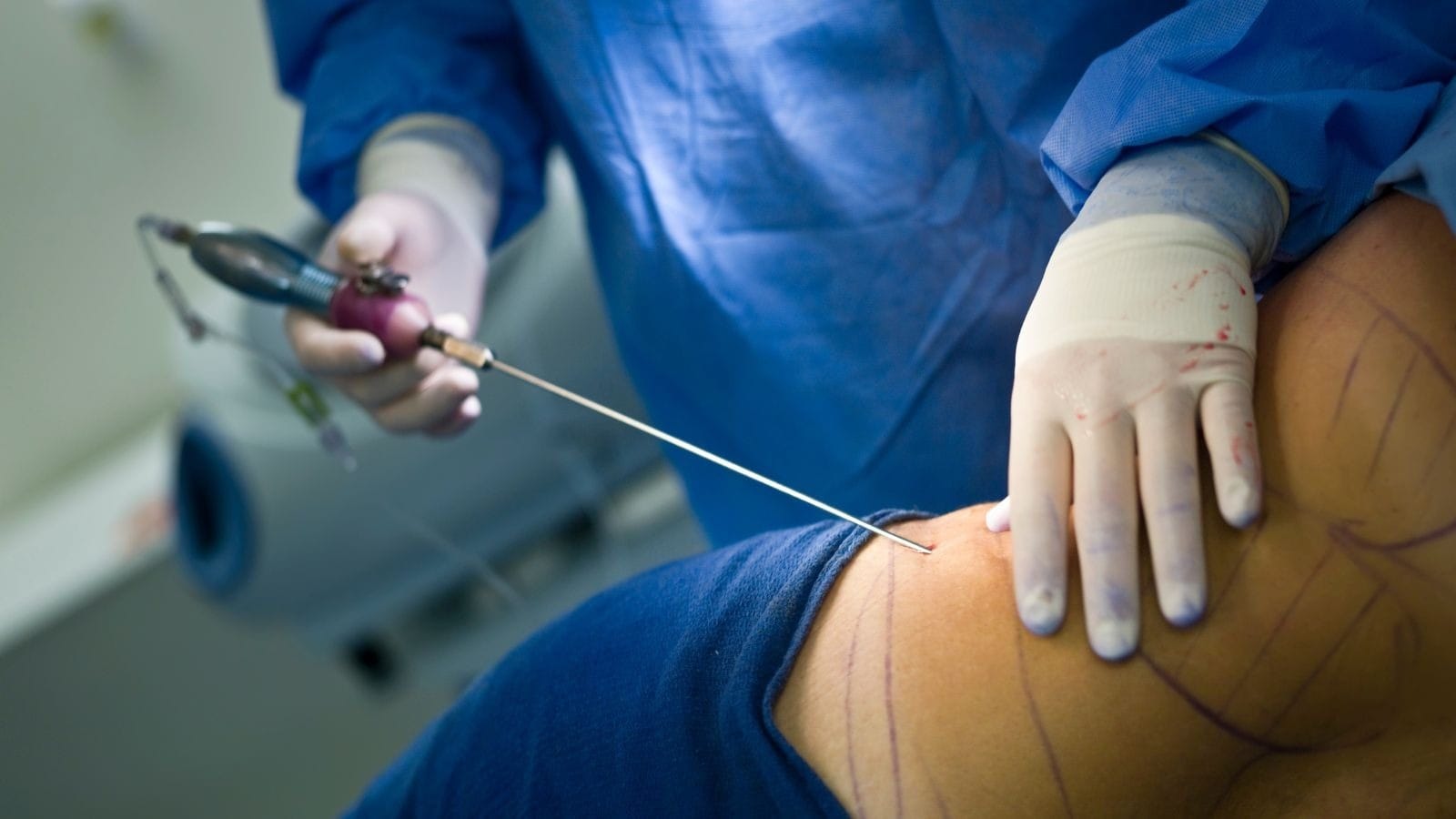 Lipoaspiração é cada vez mais popular | Reprodução/Canva