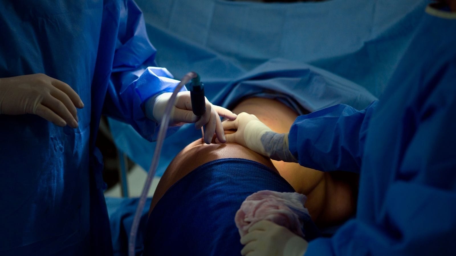 Lipoaspiração pode trazer riscos | Reprodução/Canva