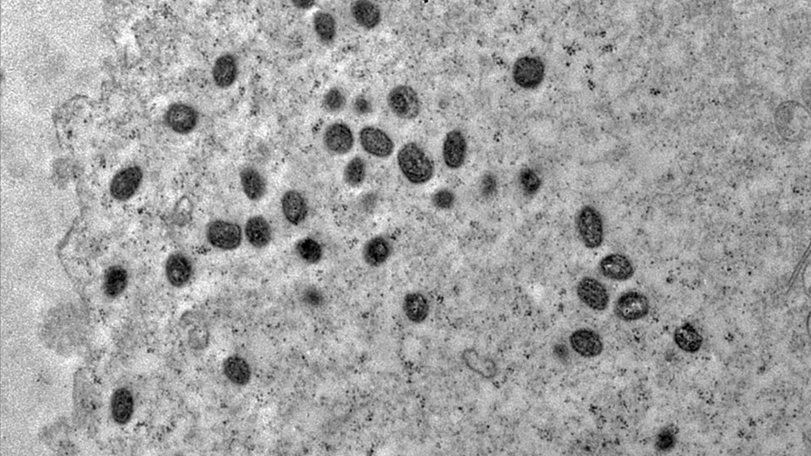 Homem com suspeita de mpox em Guarulhos testa positivo para catapora