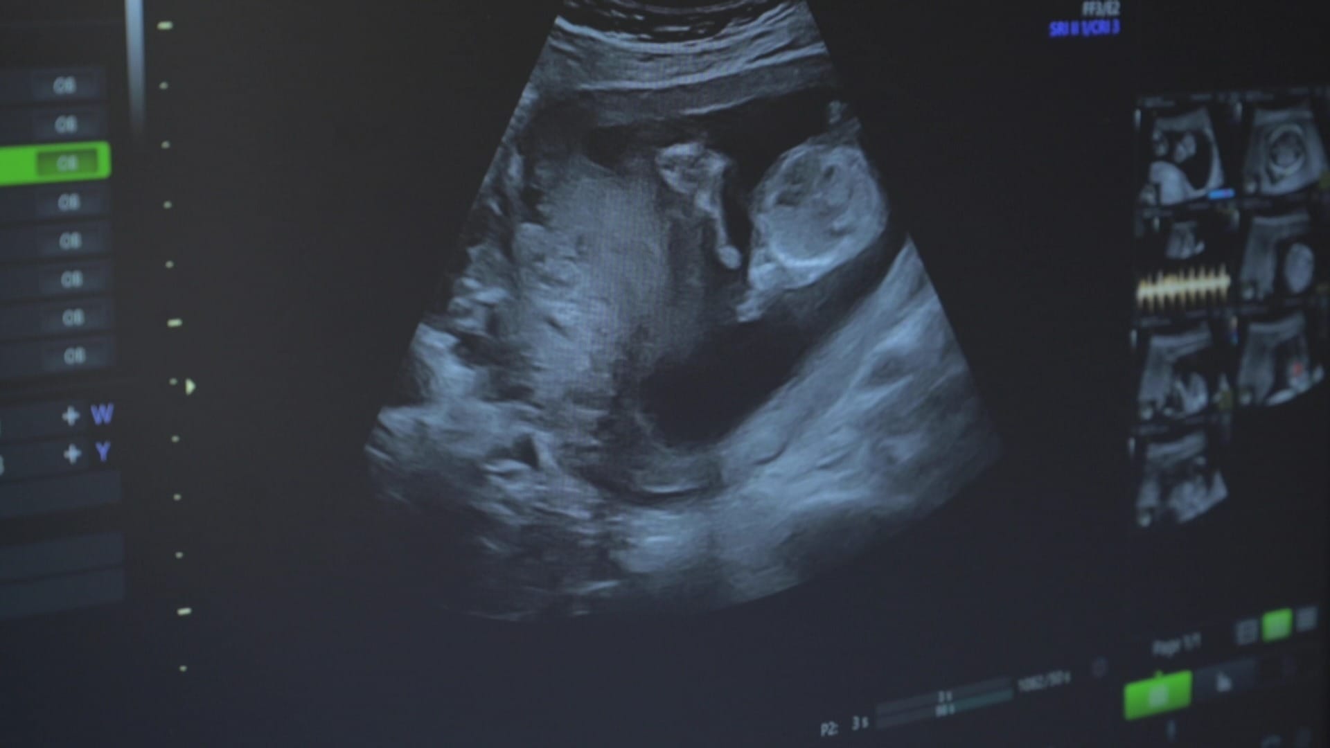Sem amparo legal, brasileiras buscam outros países para realizar aborto
