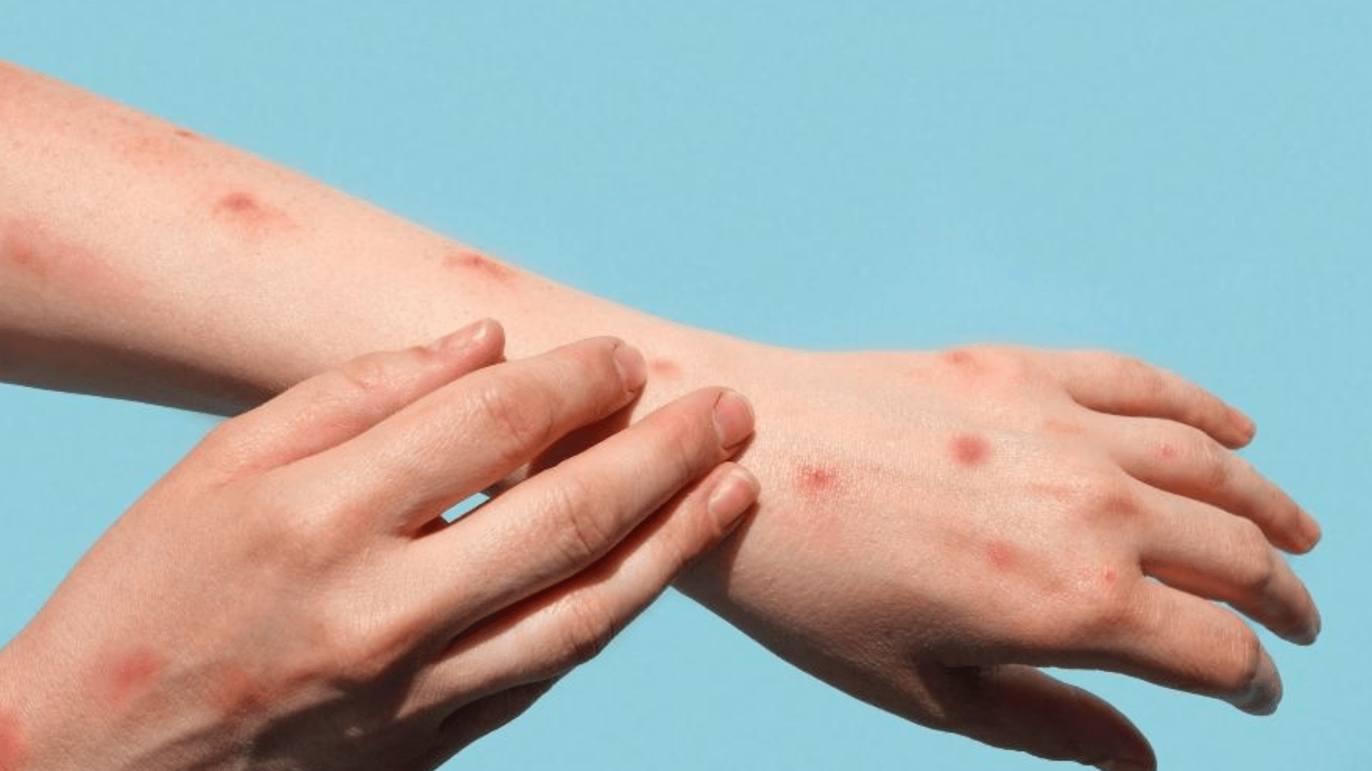 O que é Mpox? Busca pela doença cresce no Google após caso em Porto Alegre