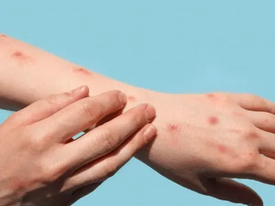 Cidade do Rio teve mais de 1.200 casos de mpox desde 2022