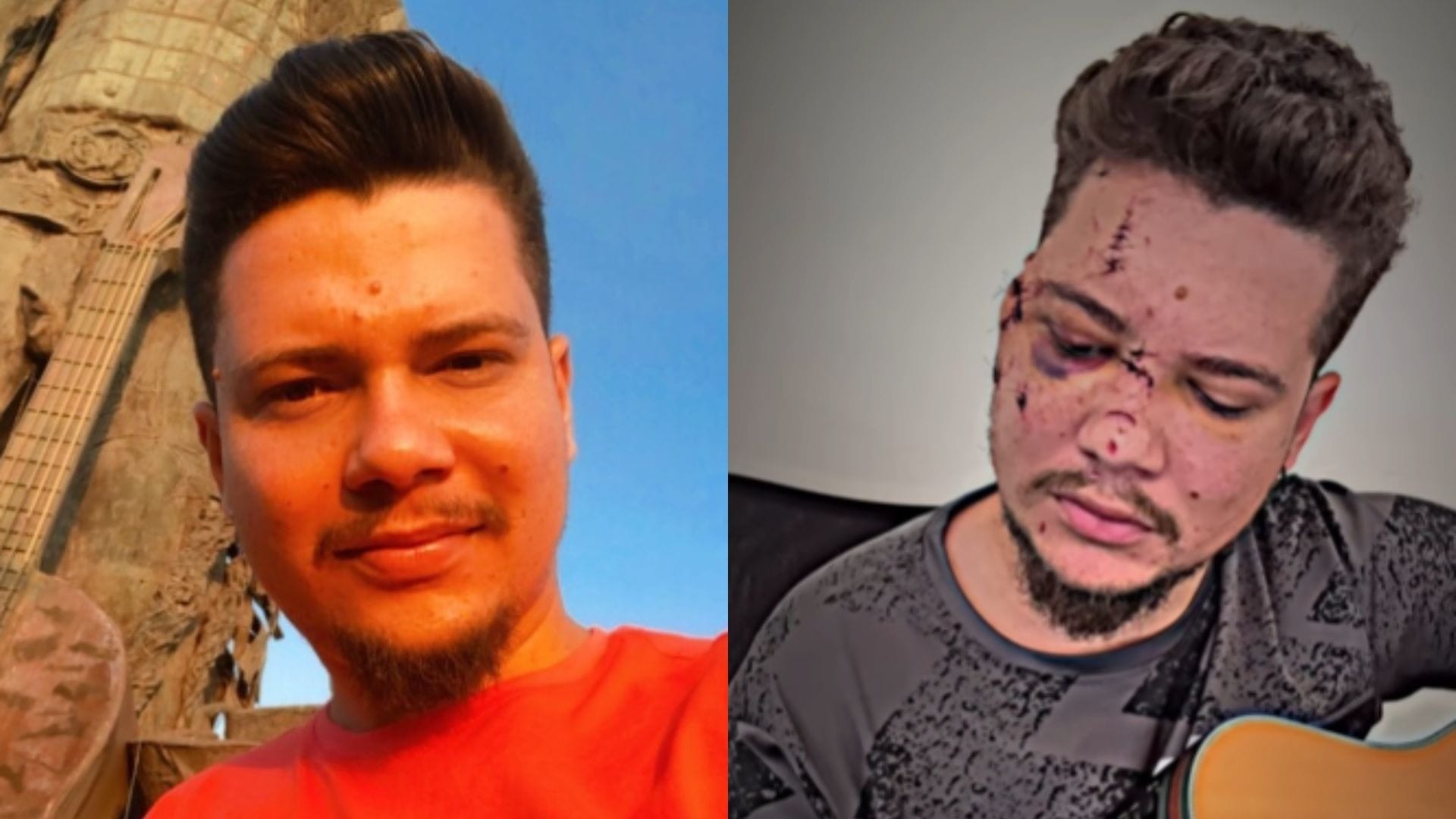 Sertanejo leva 32 pontos no rosto após ser agredido com garrafa: 'Muito difícil'