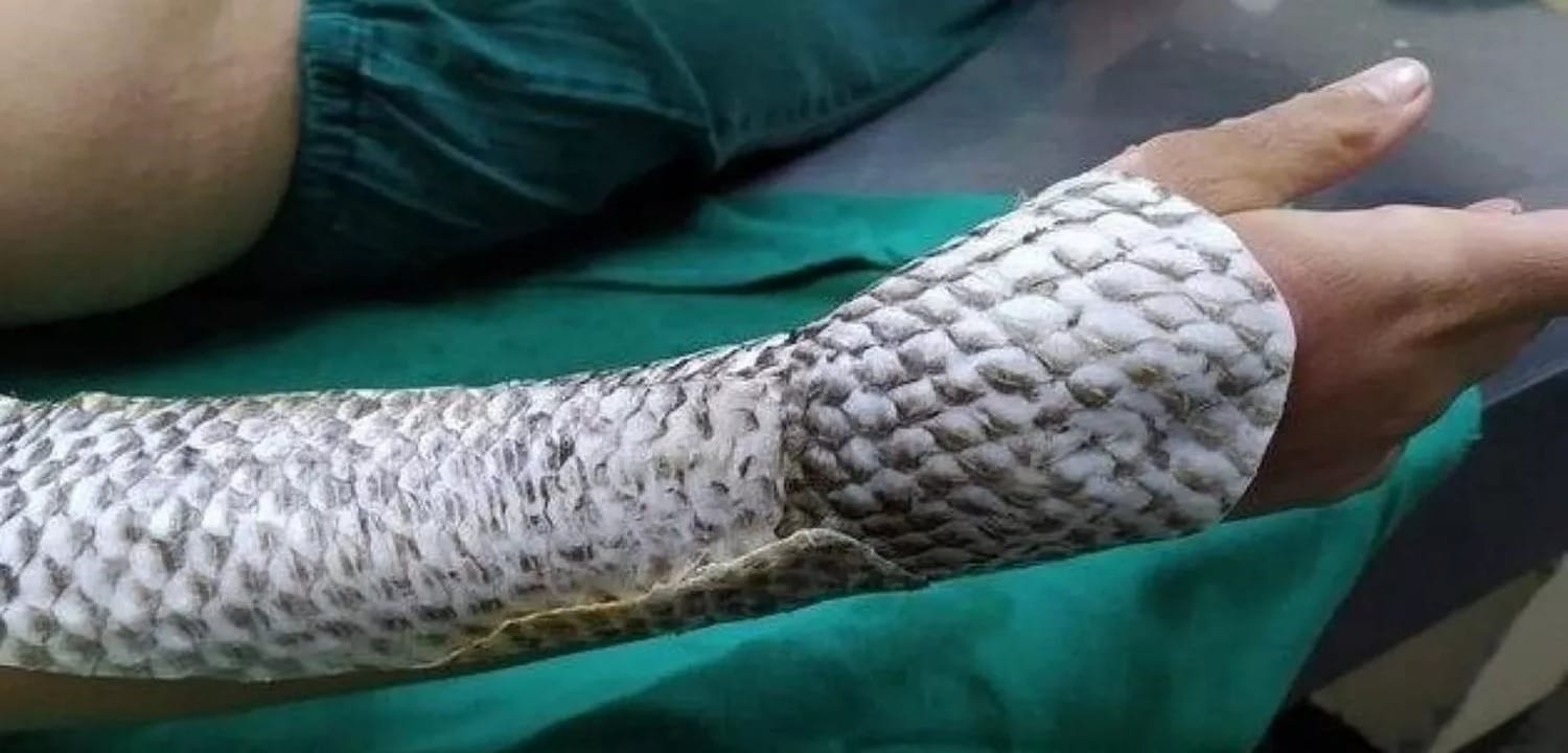 Anvisa aprova uso de pele de tilápia para tratar queimaduras