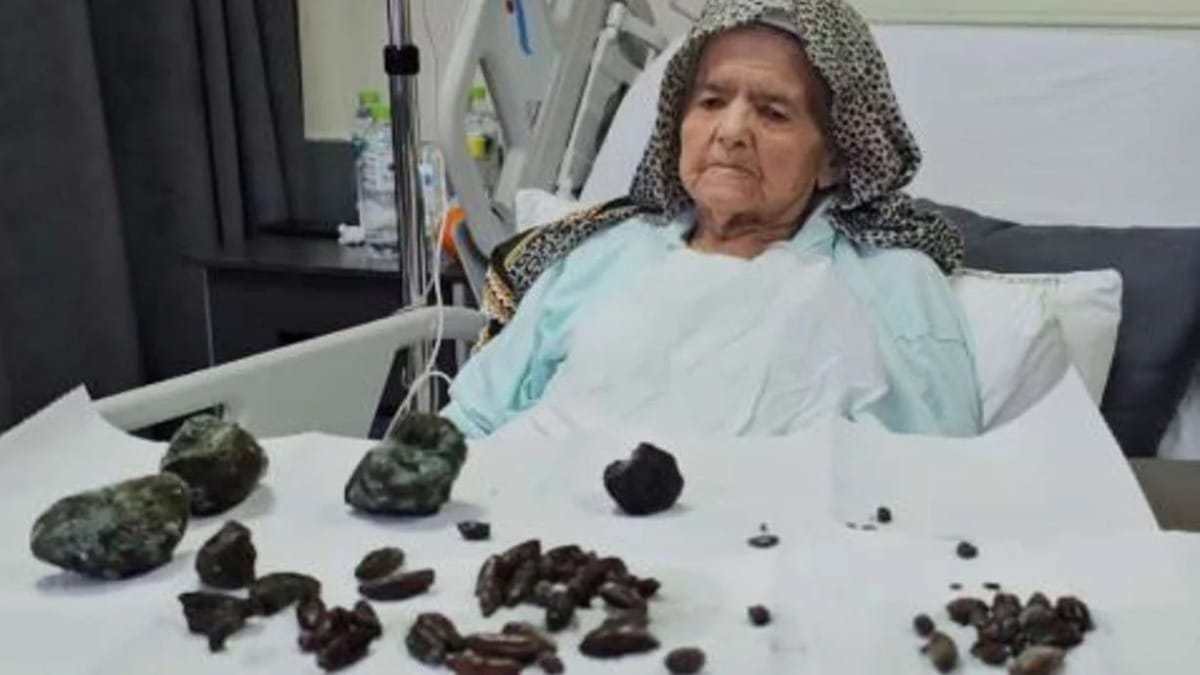 Idosa de 92 anos engole mais de 40 caroços, sementes e pedras sem perceber