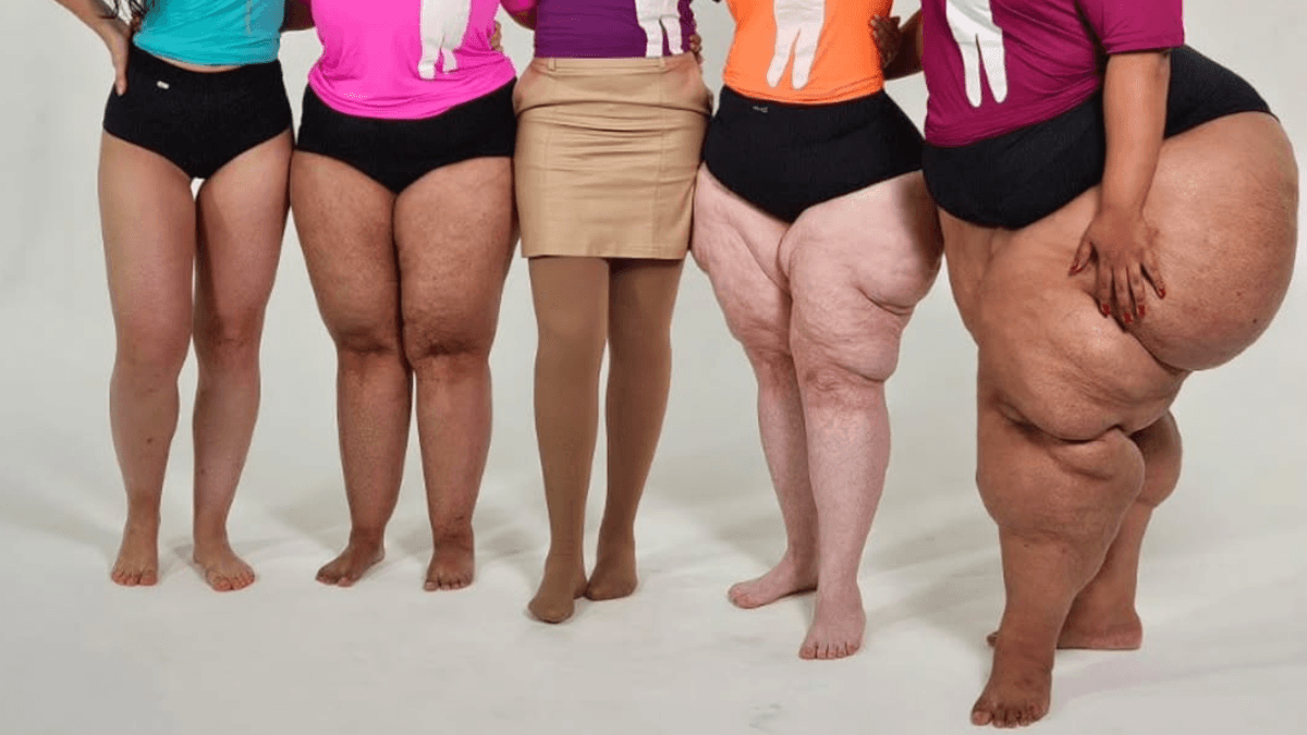 Lipedema: cerca de 11% da população feminina mundial pode ter a doença e não saber