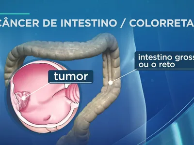 Brasil deve ter 53 mil novos casos de câncer colorretal por ano