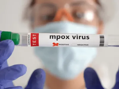 Mpox: África tem quase 50 mil casos confirmados