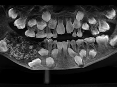 Menino de 7 anos tem 526 dentes retirados em cirurgia na Índia