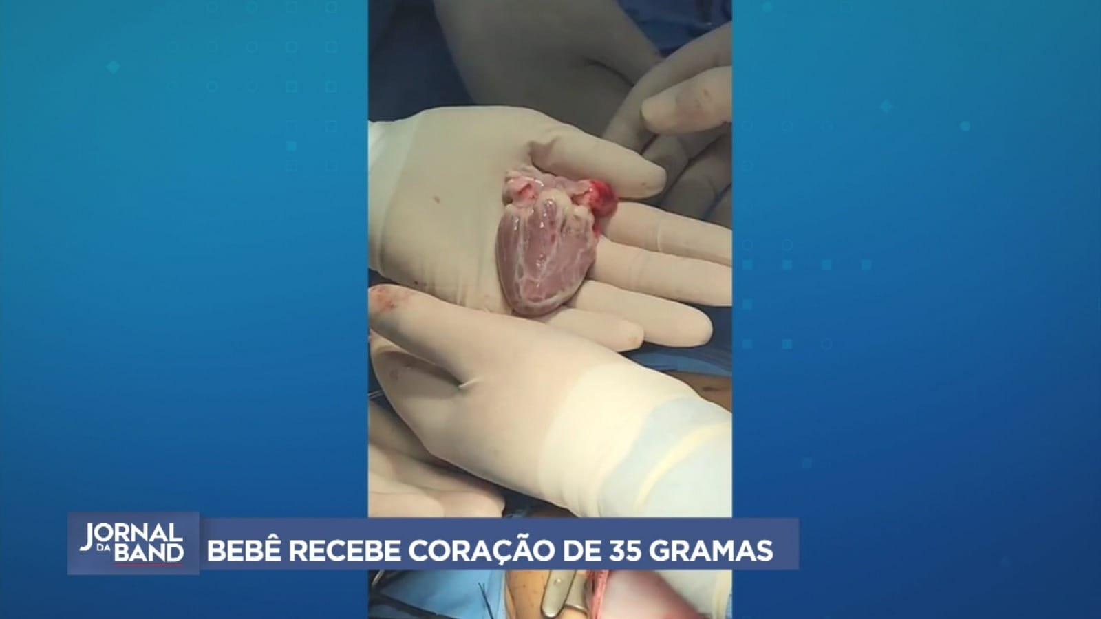 Cirurgia rara: bebê de 9 meses recebe coração de 35 gramas em São Paulo