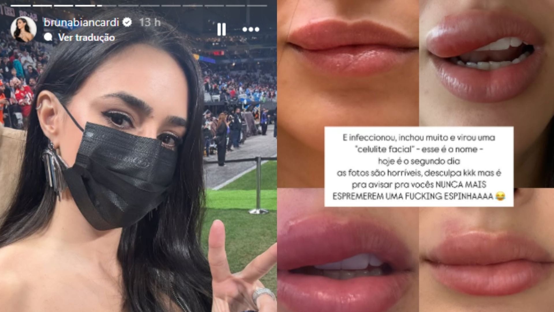 Bruna Biancardi revela tratamento contra celulite facial; entenda condição