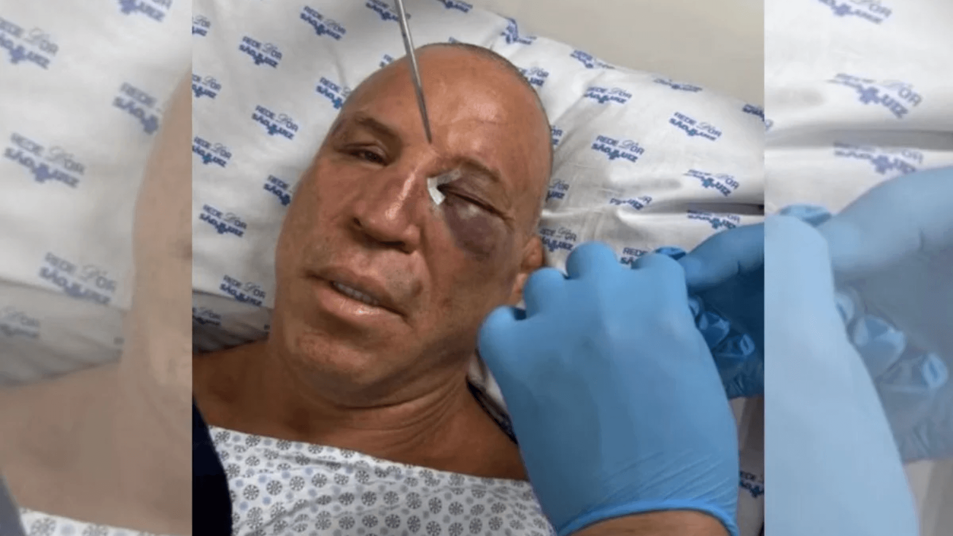 Wanderlei Silva quebra nariz e leva pontos após confusão com filho de Popó