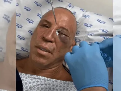 Wanderlei Silva quebra nariz e leva pontos após confusão com filho de Popó