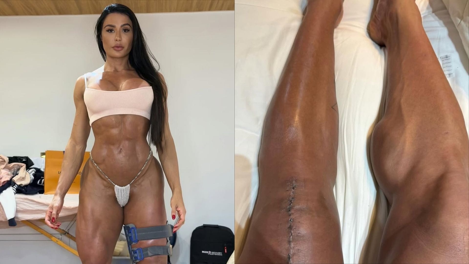Gracyanne Barbosa mostra situação do joelho 1 mês após romper tendão