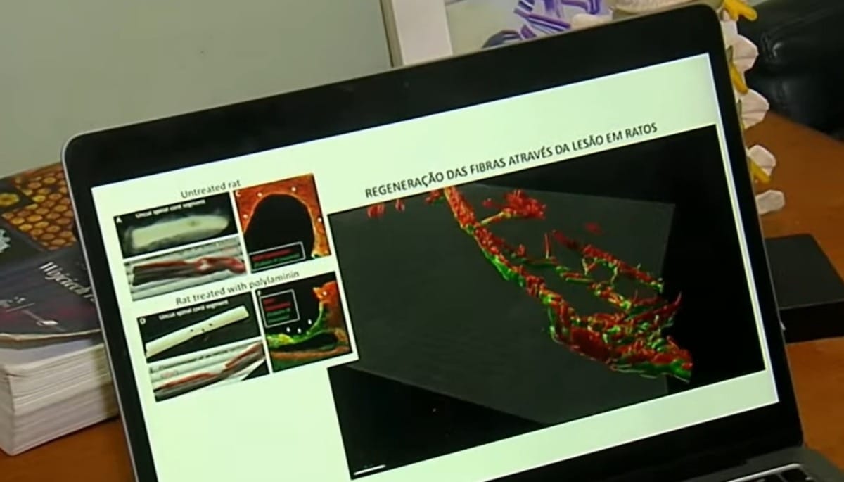 Polilaminina: substância da placenta traz avanços em casos de paralisia