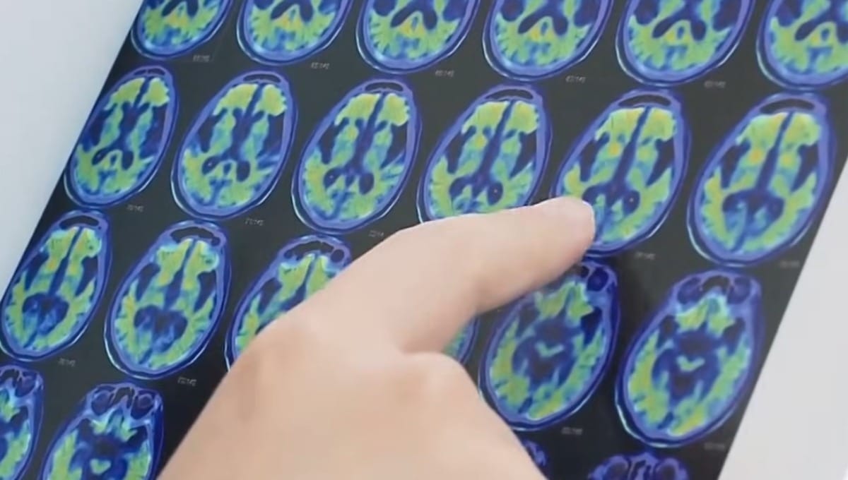 Anvisa aprova Lecanemabe, novo medicamento para tratamento de Alzheimer