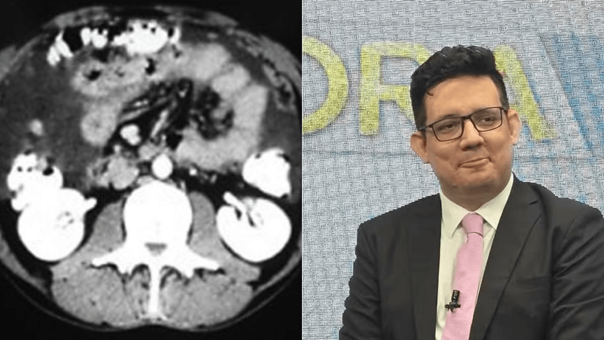 O que é tuberculose peritoneal, doença rara que matou Erlan Bastos?