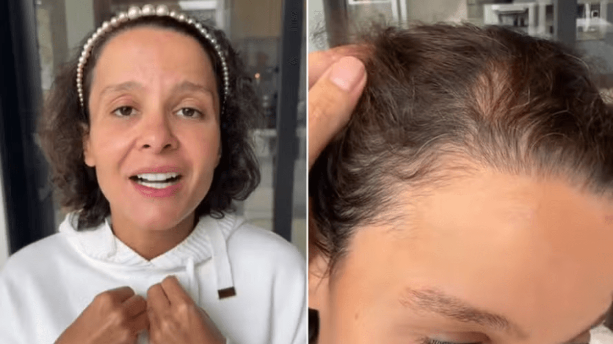 Alopecia: entenda condição que causou queda de cabelo em Maiara