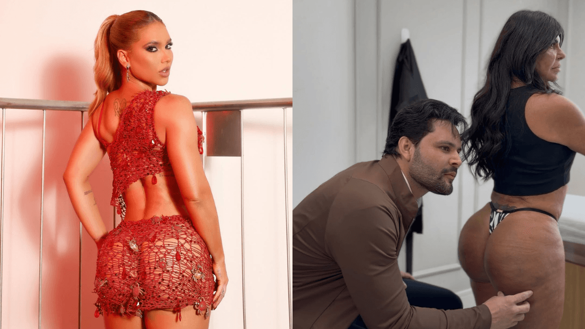 Harmonização no bumbum com bioestimuladores ganha espaço entre as famosas