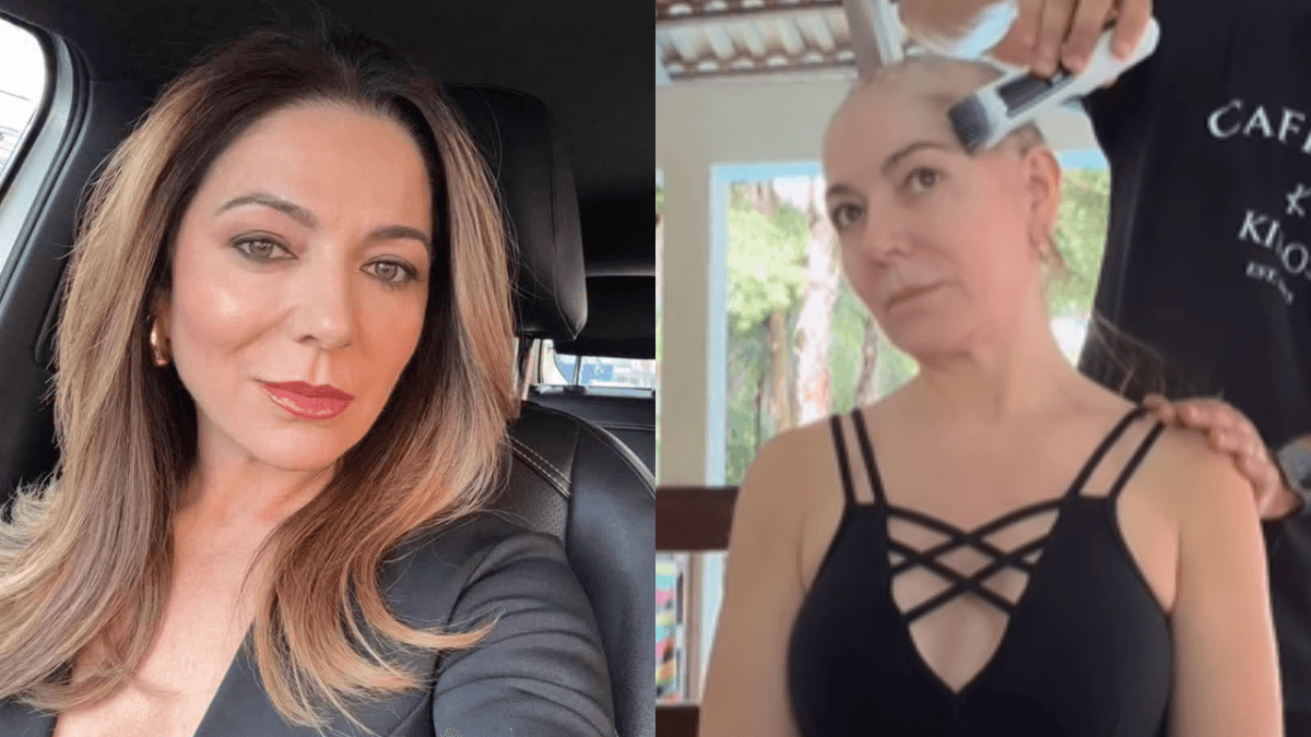Mãe de Lucas Lucco raspa cabelo após alopecia areata severa; entenda doença
