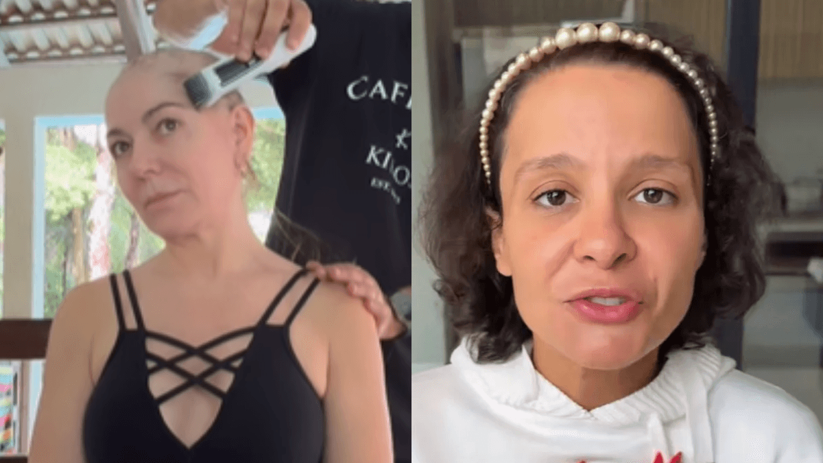 Alopecia areata x androgenética: entenda a diferença após casos de famosas