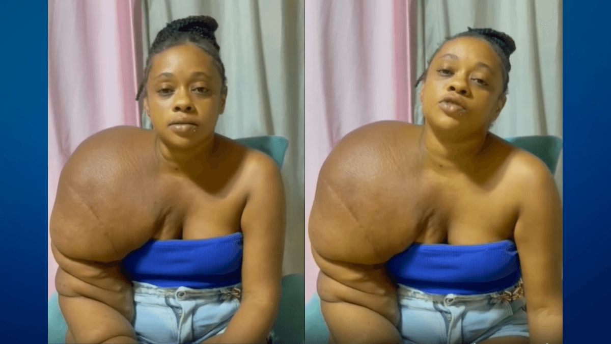 Mulher com linfedema primário faz apelo por tratamento no exterior