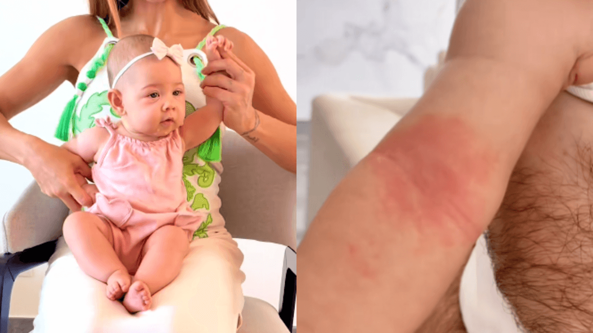 O que é APLV? Entenda a alergia enfrentada pela filha de Maíra Cardi