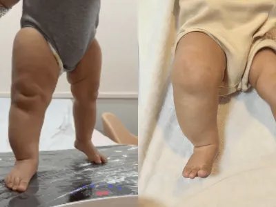 Linfedema: caso de bebê com perna inchada expõe doença comum em adultos