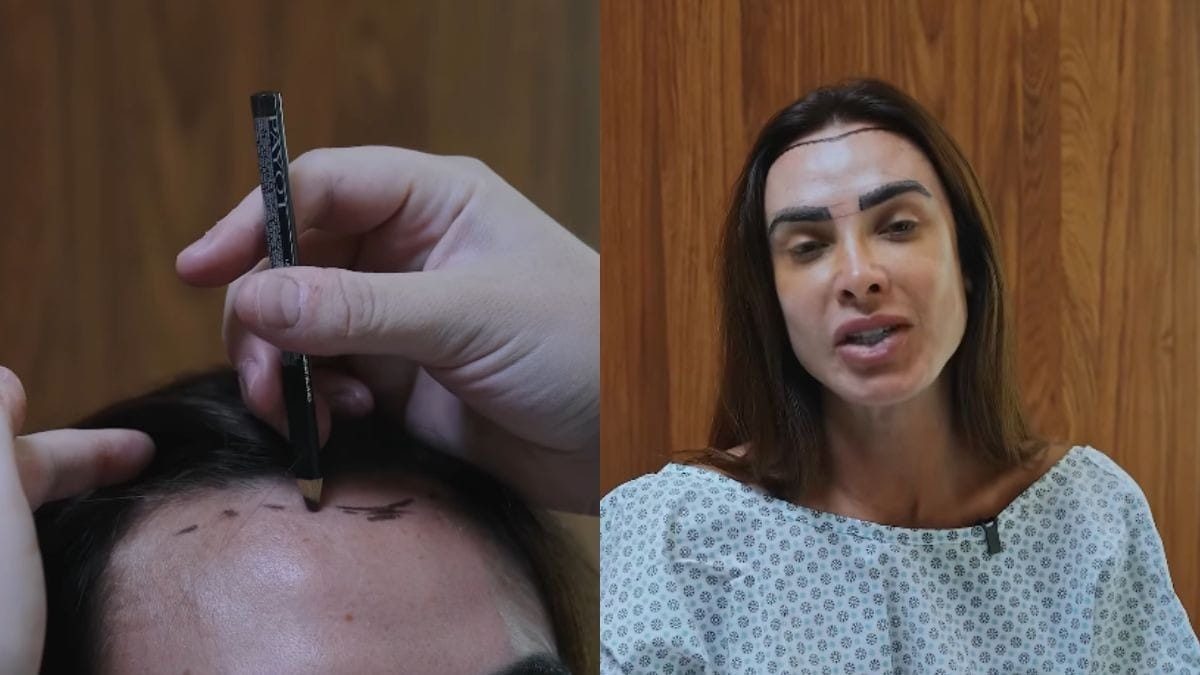 Nicole Bahls faz transplante capilar após alopecia: 