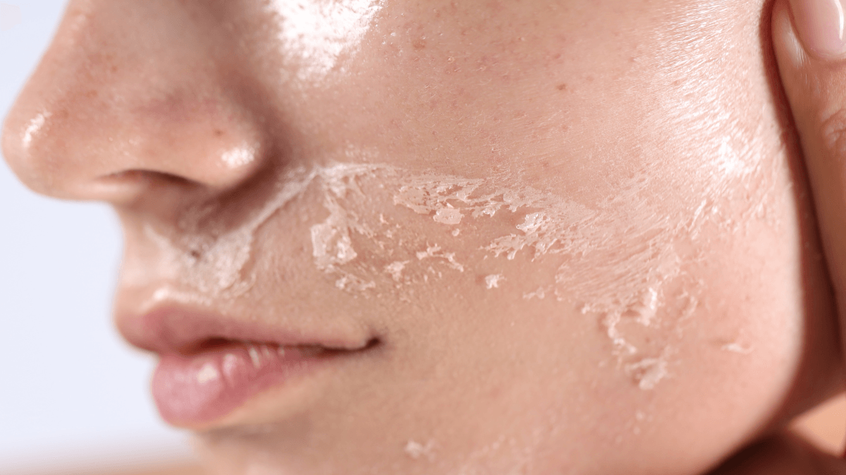 Como evitar pele ressecada no frio? Dermatologista explica os cuidados
