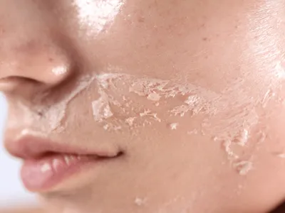 Como evitar pele ressecada no frio? Dermatologista explica os cuidados