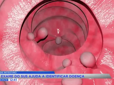 Câncer de intestino: novo exame do SUS mira diagnóstico precoce