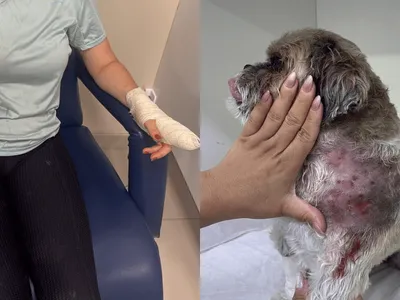 Mulher atacada por cachorro em SJCampos corre risco de perder um dedo