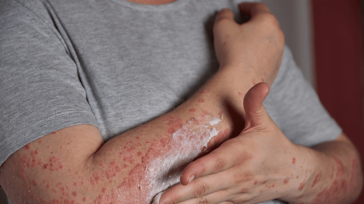 Hipertensão, anemia e diabetes são comuns em pacientes com lúpus