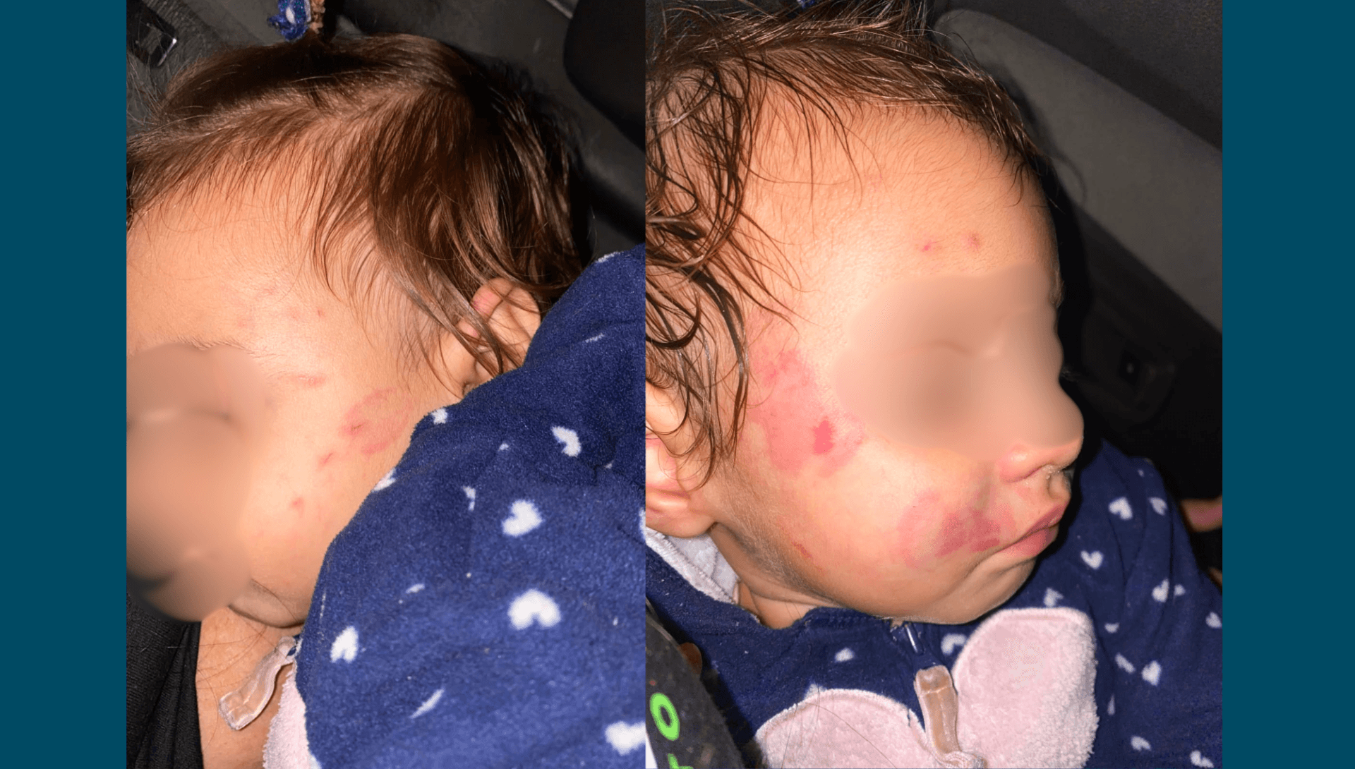 Bebê fez uma tomografia que descartou lesões mais graves