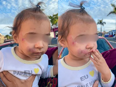 Bebê volta de creche com hematomas no rosto e mãe denuncia negligência