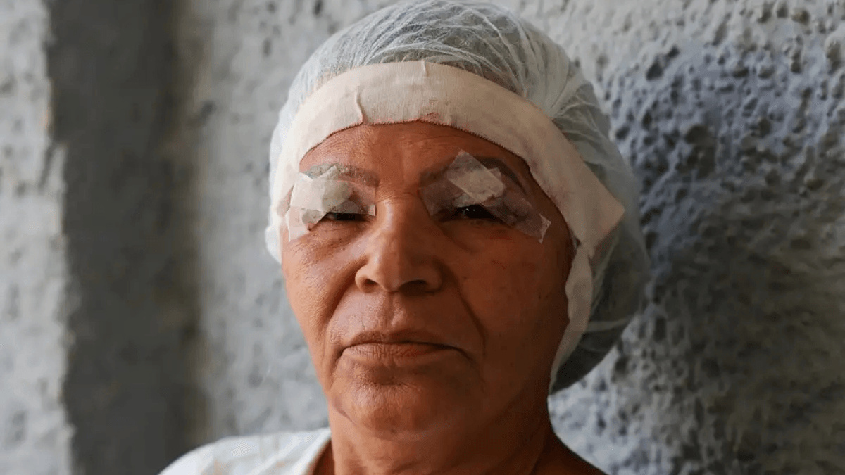 Blefaroplastia: 3ª cirurgia plástica mais feita exige avaliação cautelosa