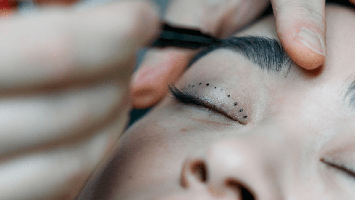 Blefaroplastia: 3ª cirurgia plástica mais feita exige avaliação cautelosa