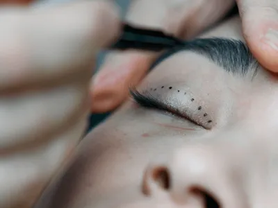 Blefaroplastia: 3ª cirurgia plástica mais feita exige avaliação cautelosa