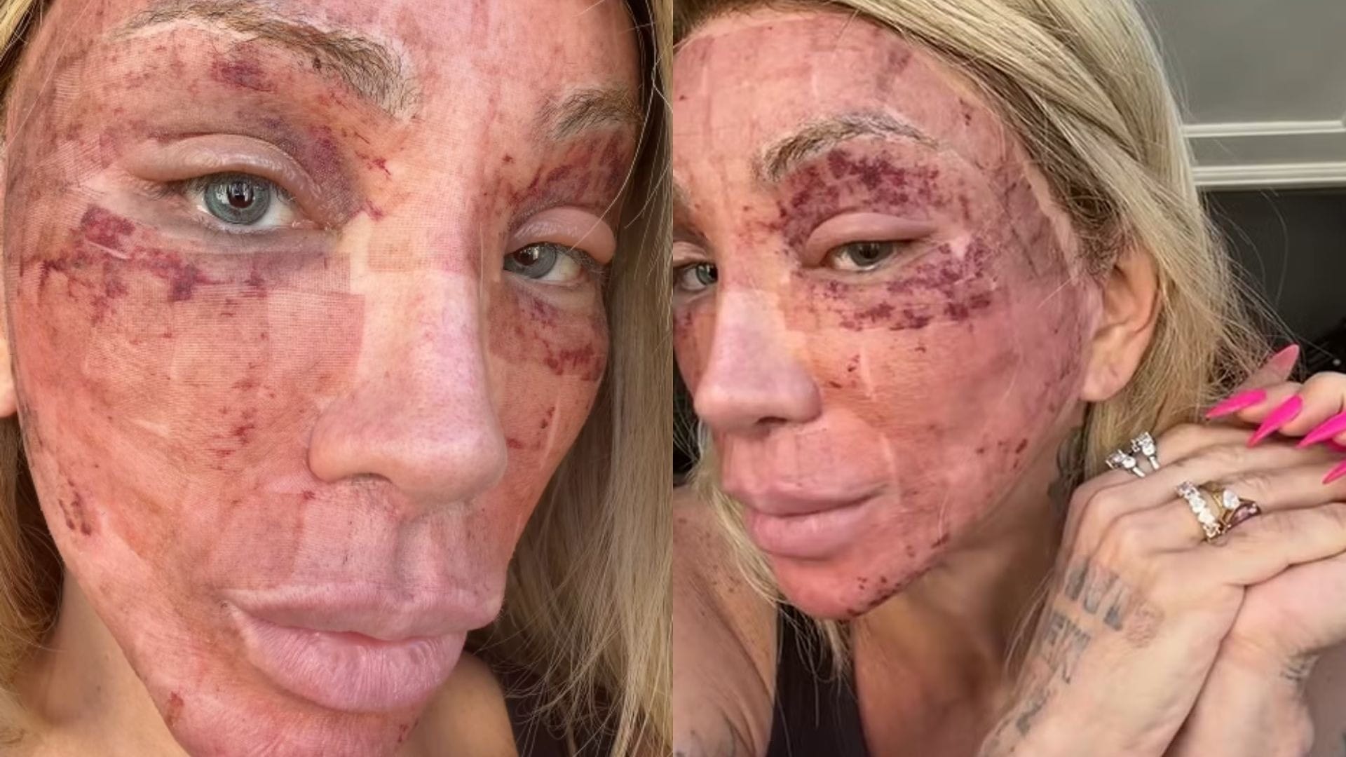 Maya Massafera mostra piora pós-peeling: 'Quanto mais incho, melhor'