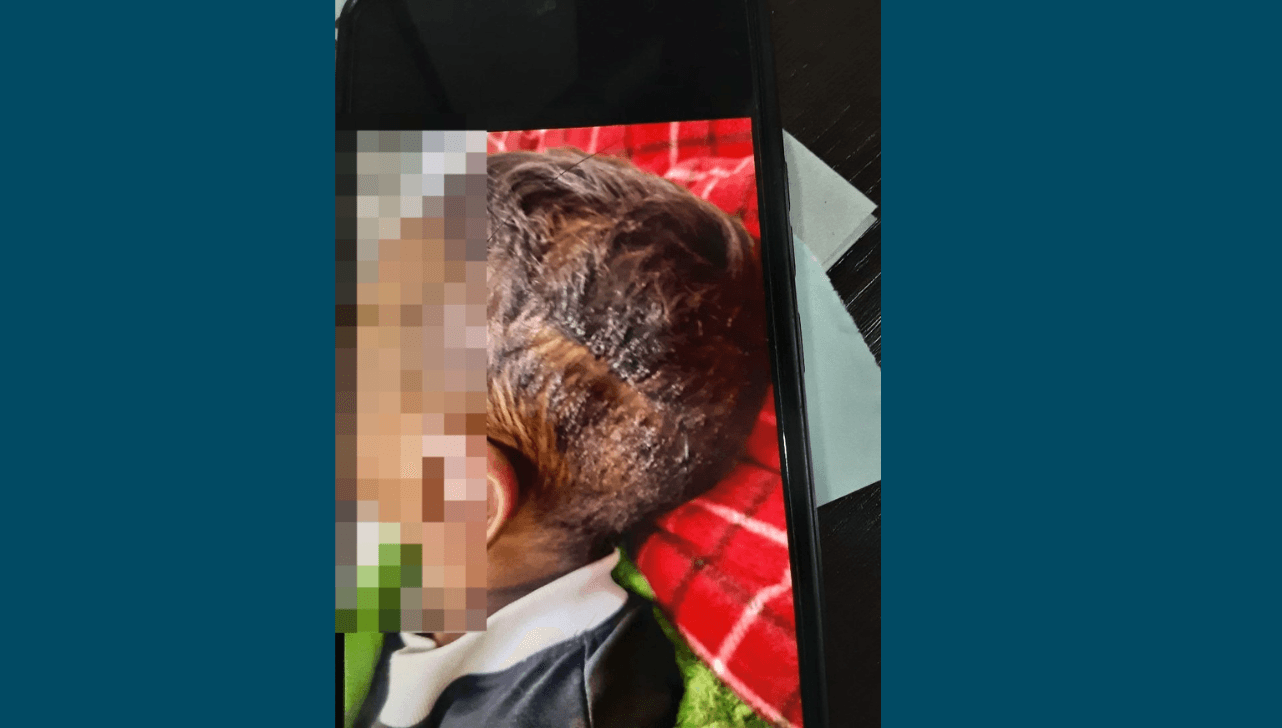 A crian&ccedil;a teve que ser internada devido aos ferimentos
