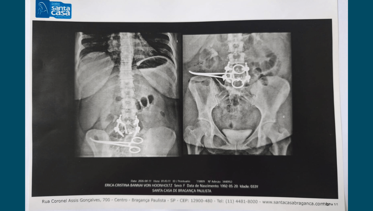 Paciente perde parte do intestino após pinça ser esquecida em cirurgia