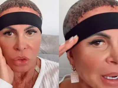 Gretchen mostra recuperação após transplante capilar: 'Estou bem'