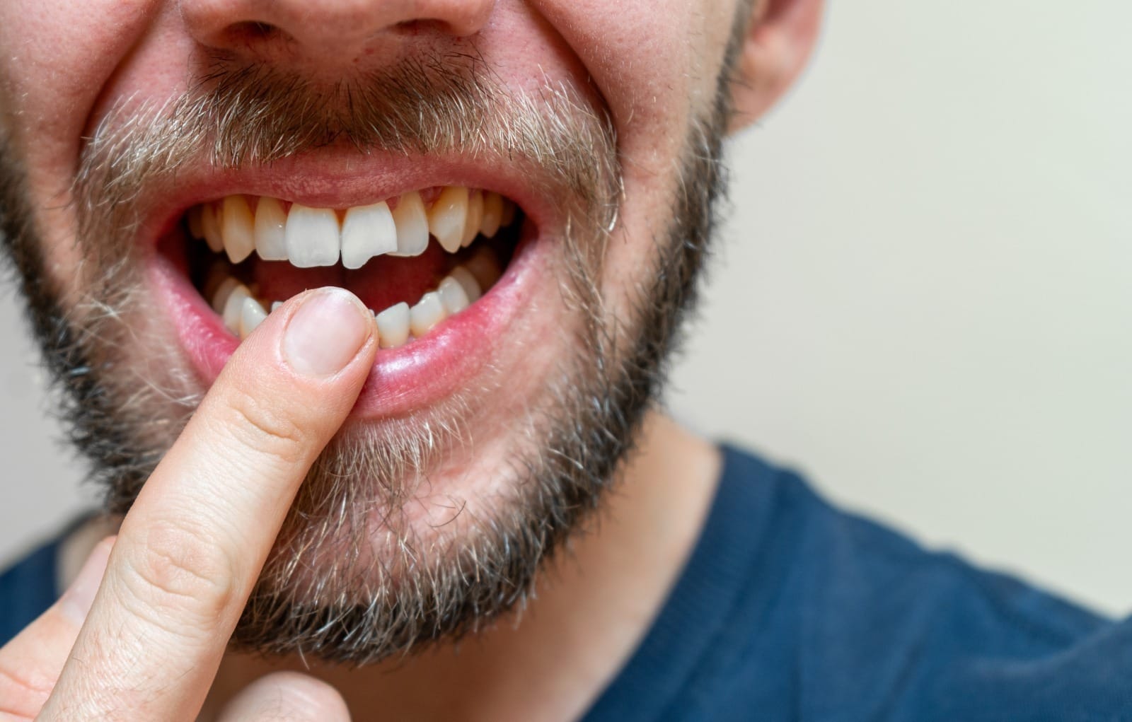 Conheça os alimentos campeões em quebrar dentes; como agir em emergências