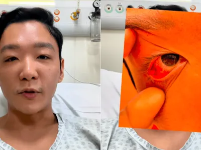 O que é celulite pós-septal, doença que atingiu ex-MasterChef César Yukio