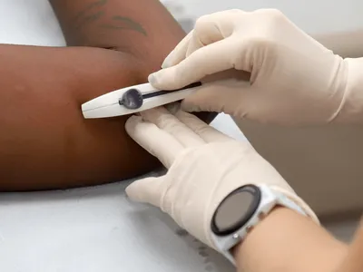 Adesão ao implante anticoncepcional cresce 553% após ampliação do acesso