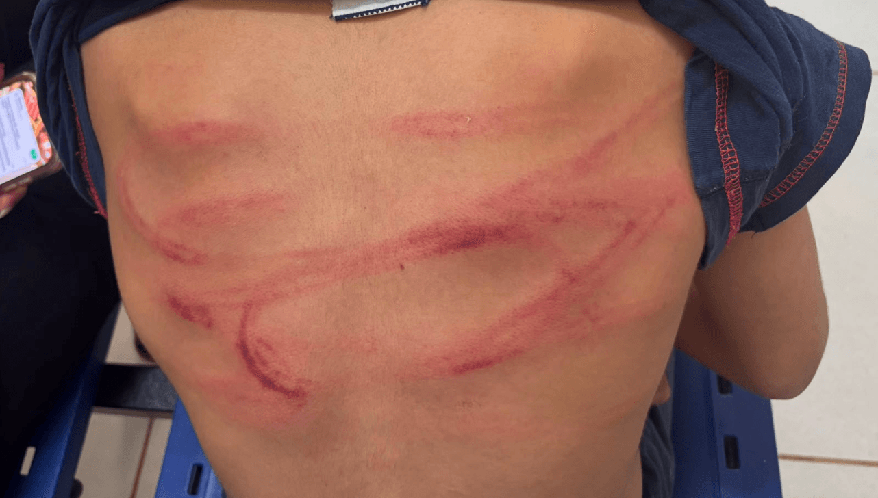 As costas da criança ficaram com as marcas da violência