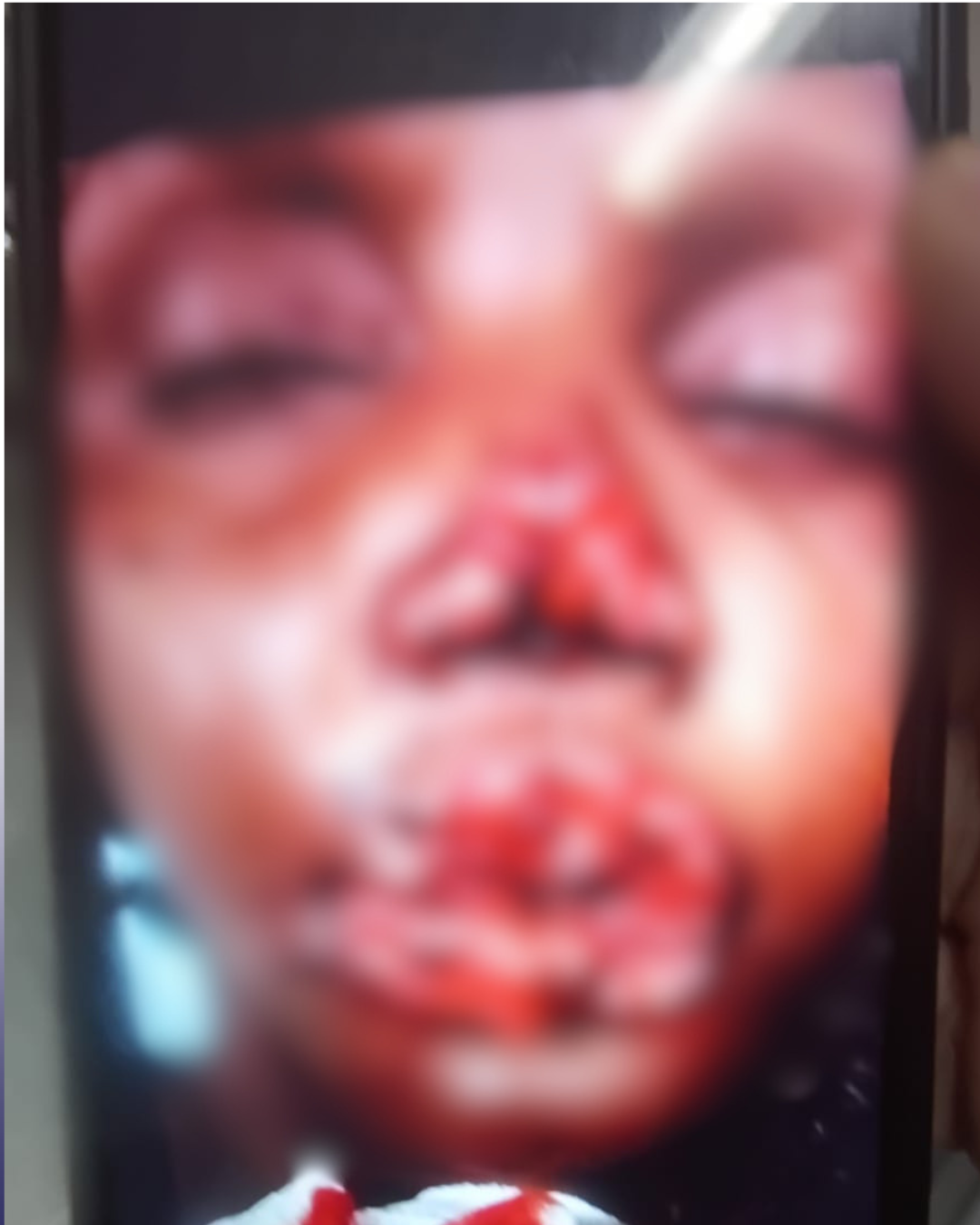 Mulher tem rosto desfigurado após ser mordida pelo companheiro